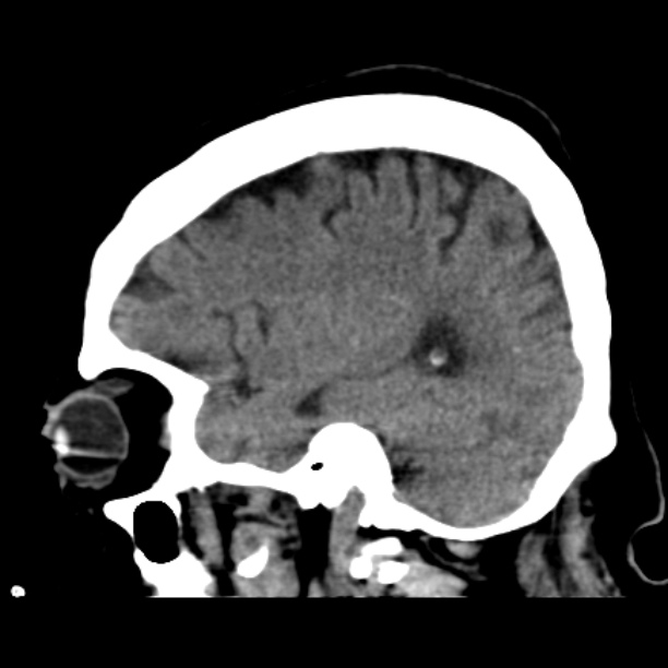 Brain cortical laminar necrosis (Radiopaedia 25822-25971 non-contrast 16).jpg
