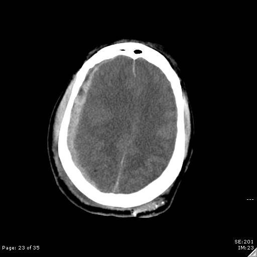 File:Brain death after motor vehicle collision (Radiopaedia 88470-105114 Axial non-contrast 23).jpg