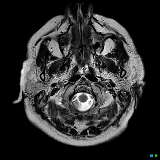 File:Brain death on MRI and CT angiography (Radiopaedia 42560-45689 Axial T2 3).jpg