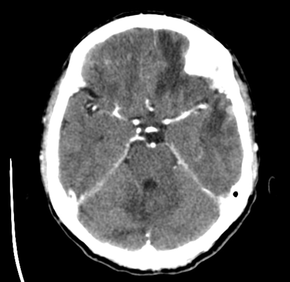 File:Brain metastases from lung cancer (Radiopaedia 24480-24781 Axial C+ delayed 18).jpg
