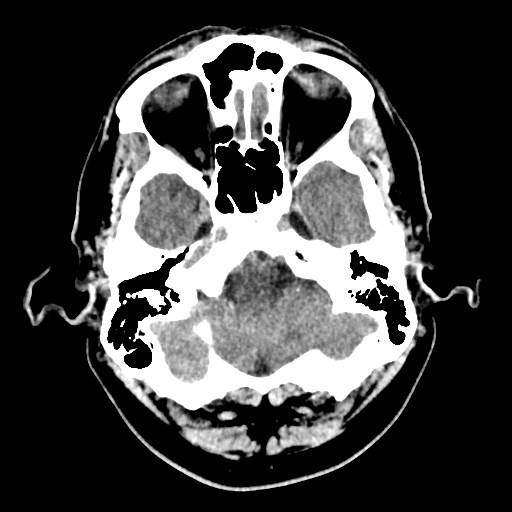 File:Brain metastases from lung cancer (Radiopaedia 83839-99027 Axial non-contrast 6).jpg