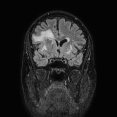 Brain metastases from lung cancer (Radiopaedia 83839-99028 Coronal FLAIR 25).jpg