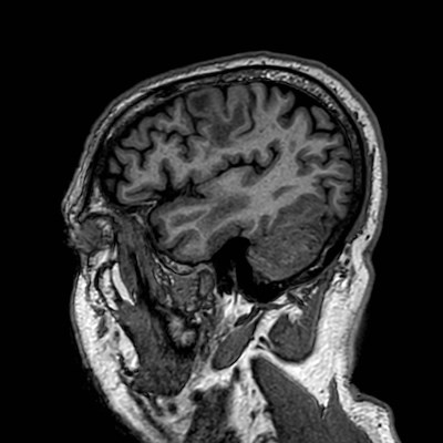 Brain metastases from lung cancer (Radiopaedia 83839-99028 Sagittal T1 105).jpg