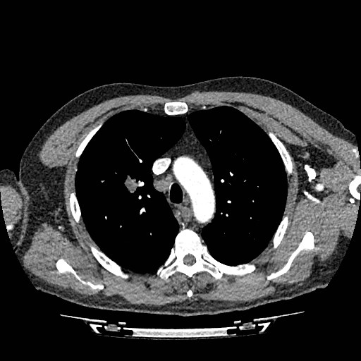 File:Brain metastases from lung cancer (Radiopaedia 83839-99030 B 22).jpg