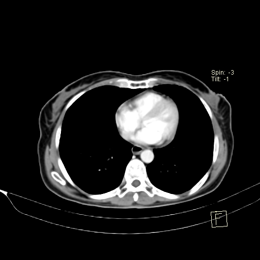 Brain metastasis as initial presentation of non-small cell lung cancer (Radiopaedia 65122-74127 A 31).jpg
