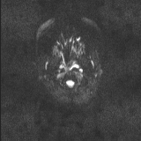 Brainstem glioma (Radiopaedia 67531-76922 Axial DWI 26).jpg