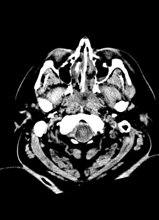 Brainstem hemorrhage (Radiopaedia 81294-94976 Axial non-contrast 58).jpg