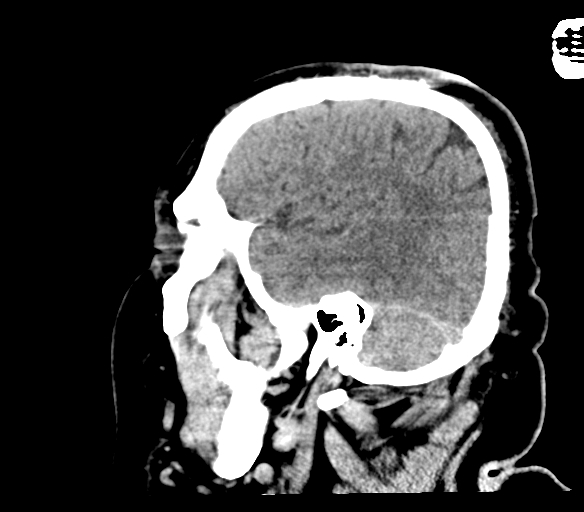Brainstem hemorrhage (Radiopaedia 81294-94976 C 46).jpg