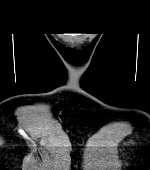 Branchial cleft cyst (Radiopaedia 31167-31875 Coronal C+ delayed 65).jpg