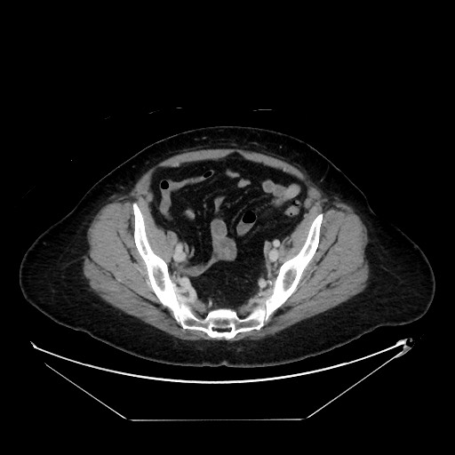 File:Breast cancer pseudocirrhosis with lobar invovlement (Radiopaedia 81080-94670 A 128).jpg
