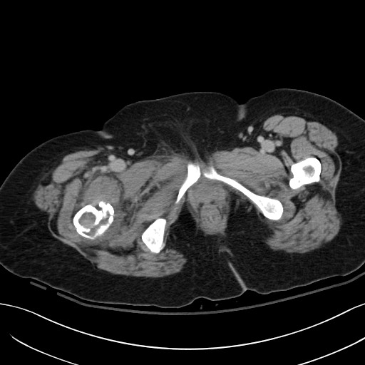 Breast carcinoma with pathological hip fracture (Radiopaedia 60314-67974 B 77).jpg
