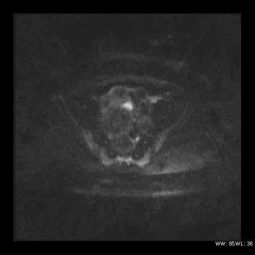 File:Broad ligament fibroid (Radiopaedia 49135-54241 Axial DWI 17).jpg