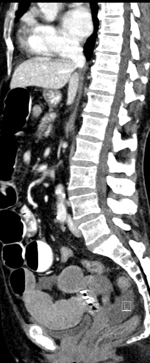 Broad ligament hernia (Radiopaedia 84802-100276 C 39).jpg