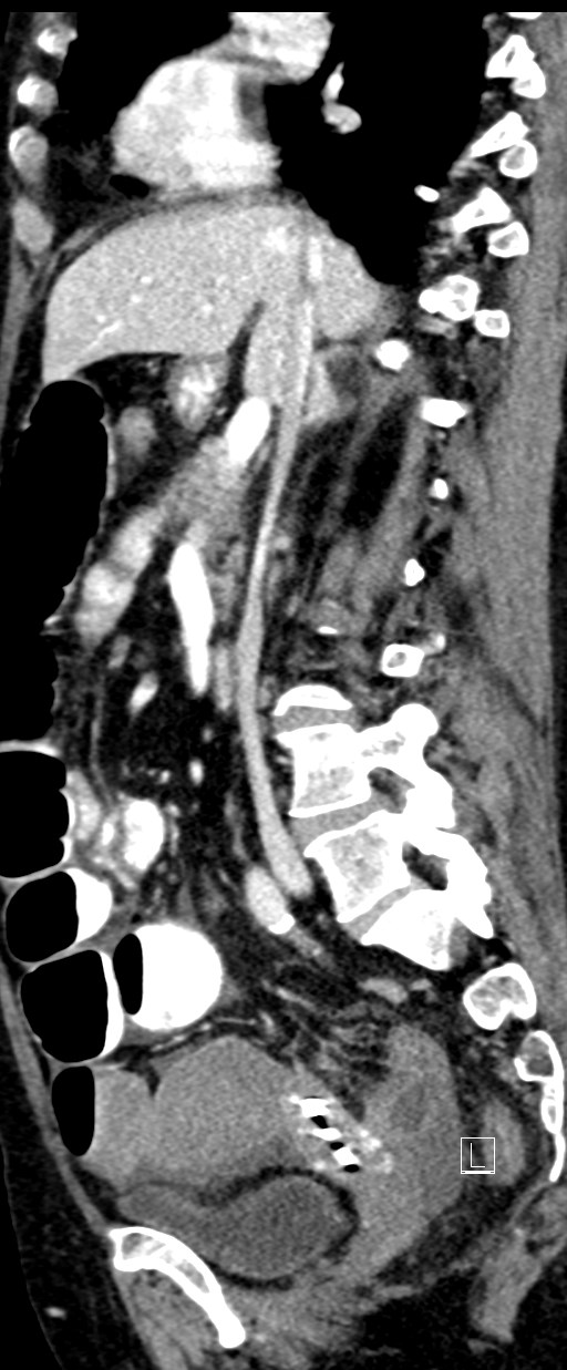 Broad ligament hernia (Radiopaedia 84802-100276 C 45).jpg