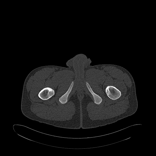 Brodie abscess- femoral neck (Radiopaedia 53862-59966 Axial bone window 216).jpg