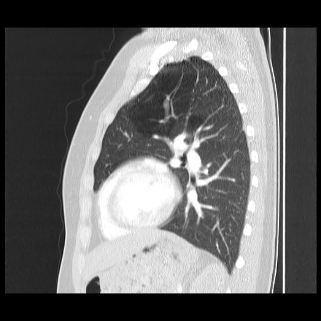 Bronchial atresia (Radiopaedia 22965-22992 Sagittal lung window 20).jpg