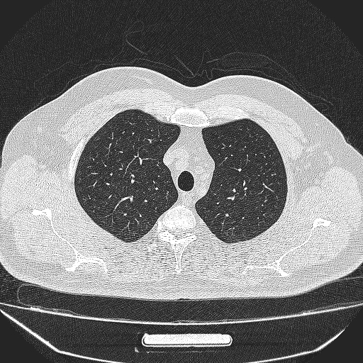 File:Bronchial atresia (Radiopaedia 58271-65417 Axial lung window 8).jpg