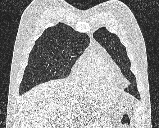 Bronchial atresia (Radiopaedia 58271-65417 Coronal lung window 10).jpg