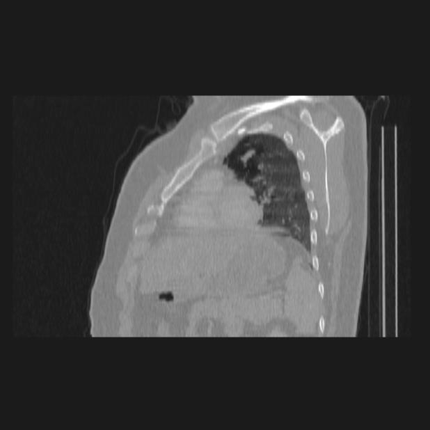 Bronchial atresia (Radiopaedia 60685-68439 Sagittal lung window 66).jpg