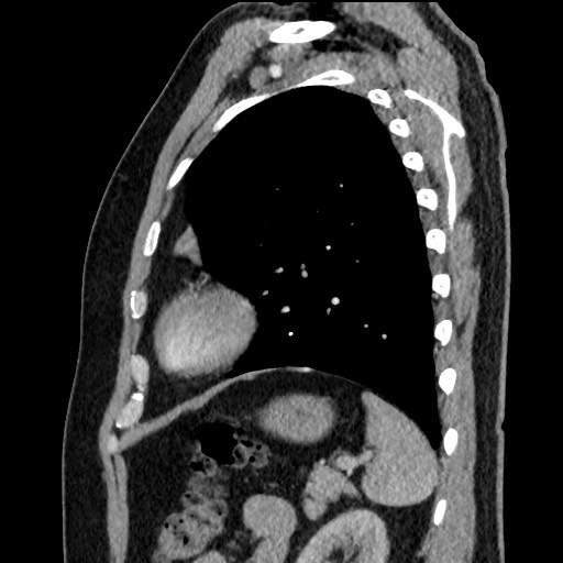 Bronchial carcinoid tumor (Radiopaedia 67377-76764 E 53).jpg
