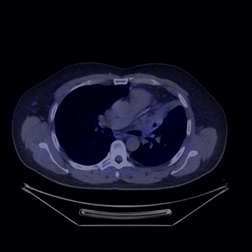 Bronchial carcinoid tumor (Radiopaedia 67377-76765 68Ga-DOTATATE PET-CT 31).jpg