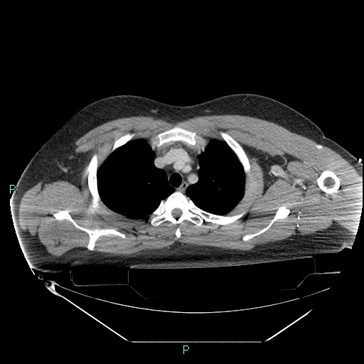 Bronchial carcinoid tumor (Radiopaedia 78272-90870 C 32).jpg