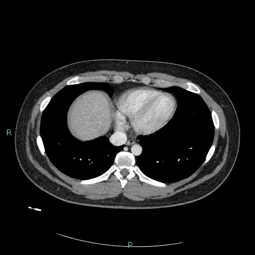 Bronchial carcinoid tumor (Radiopaedia 78272-90875 A 72).jpg