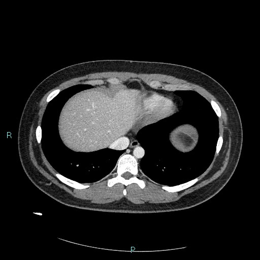 Bronchial carcinoid tumor (Radiopaedia 78272-90875 A 76).jpg