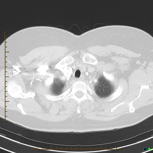 Bronchial diverticula (Radiopaedia 79512-92675 Axial lung window 6).jpg