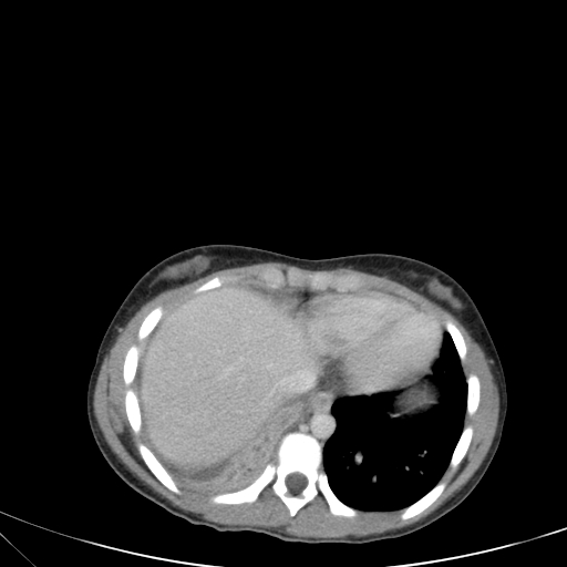 Bronchial mucoepidermoid carcinoma (Radiopaedia 57023-63895 Axial 78).jpg