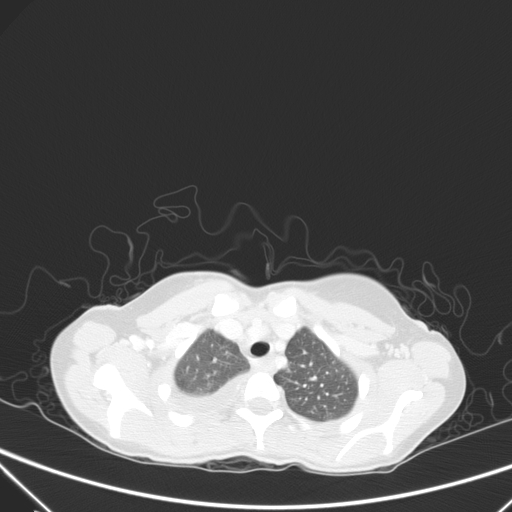 Bronchial mucoepidermoid carcinoma (Radiopaedia 57023-63895 Axial lung window 14).jpg
