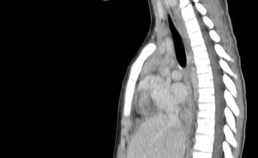 Bronchial mucoepidermoid carcinoma (Radiopaedia 57023-63895 Sagittal 112).jpg