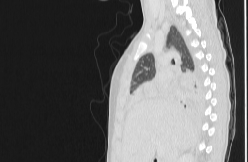Bronchial mucoepidermoid carcinoma (Radiopaedia 57023-63895 Sagittal lung window 51).jpg