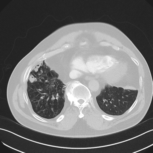 File:Bronchiectasis (Radiopaedia 39385-41666 Axial lung window 50).png
