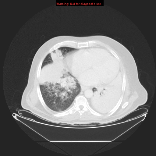 File:Bronchioloalveolar carcinoma (Radiopaedia 9272-9955 Axial lung window 21).jpg