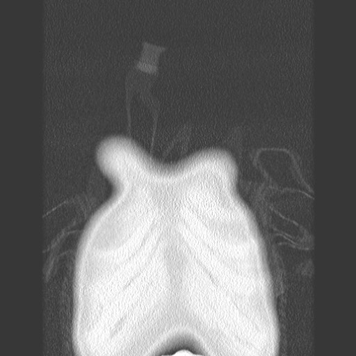 File:Bronchiolotis obliterans (Radiopaedia 73769-84575 Coronal lung window 3).jpg