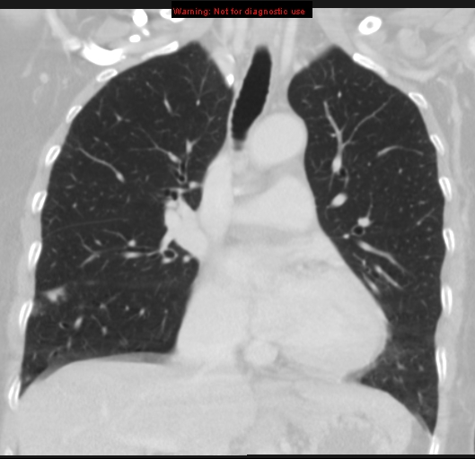 Bronchoalveolar carcinoma (BAC) (Radiopaedia 13436-13392 Coronal lung window 26).jpg