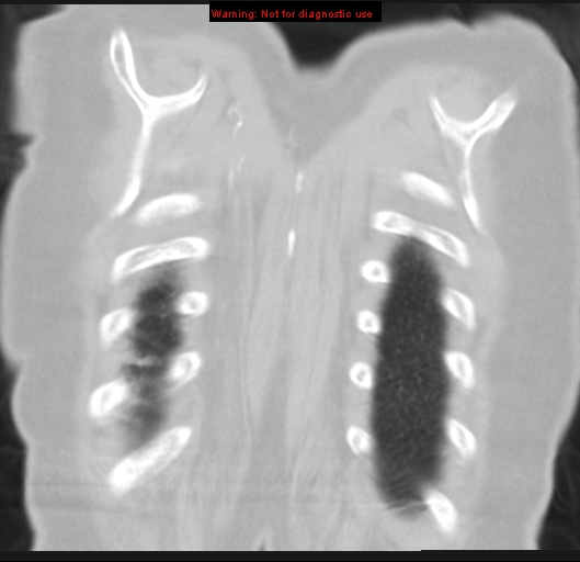 Bronchoalveolar carcinoma (BAC) (Radiopaedia 13436-13392 Coronal lung window 56).jpg