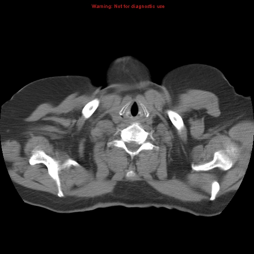 Bronchoalveolar carcinoma (Radiopaedia 13224-13233 Axial non-contrast 1).jpg