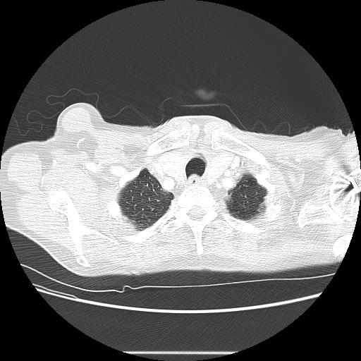 Bronchocele (Radiopaedia 17097-16795 Axial lung window 12).jpg
