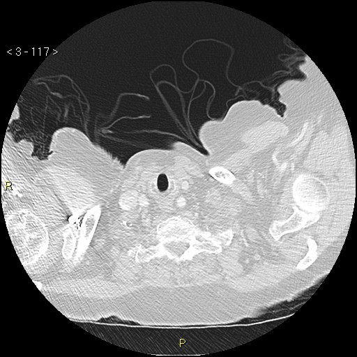 Bronchogenic carcinoma as an incidental finding (Radiopaedia 16453-16130 Axial lung window 117).jpg