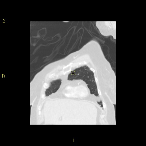 File:Bronchogenic carcinoma as an incidental finding (Radiopaedia 16453-16130 Coronal lung window 13).jpg