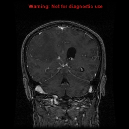 File:Bronchogenic carcinoma brain metastasis (Radiopaedia 9286-9969 Coronal T1 4).jpg