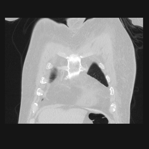 File:Bronchogenic carcinoma with metastatic lymphadenopathy (Radiopaedia 37671-39569 Coronal lung window 7).jpg