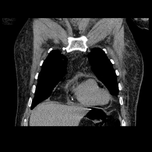 File:Bronchogenic carcinoma with metastatic lymphadenopathy (Radiopaedia 37671-39569 Coronal non-contrast 11).jpg