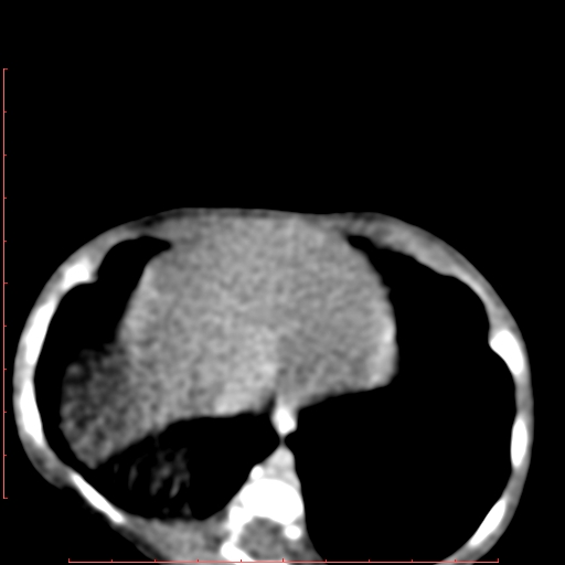 Bronchogenic cyst (Radiopaedia 78599-91409 B 163).jpg