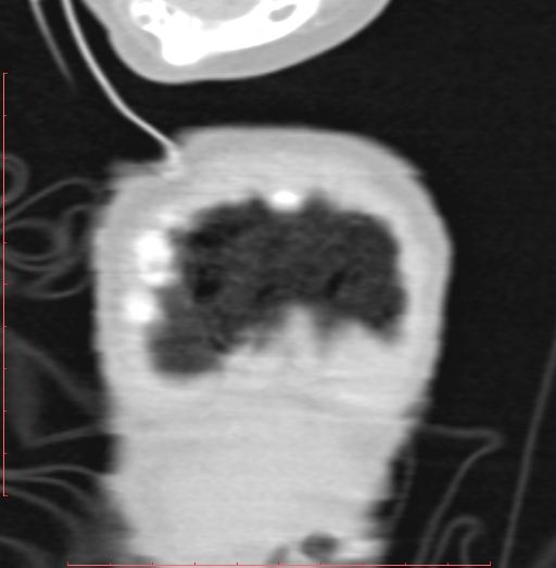 Bronchogenic cyst (Radiopaedia 78599-91409 Coronal lung window 14).jpg