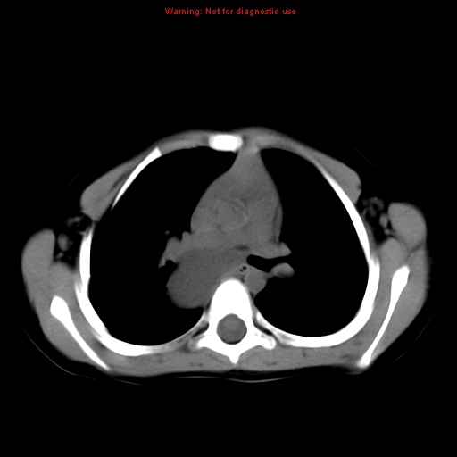 File:Bronchogenic cyst (Radiopaedia 9372-10063 Axial non-contrast 8).jpg