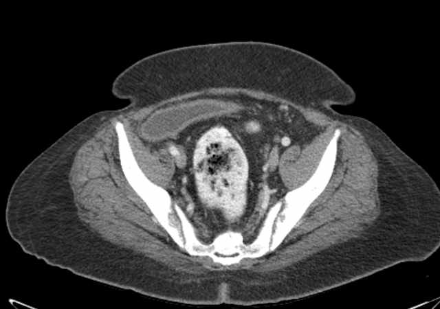 Brown tumors compressing the spinal cord (Radiopaedia 68442-77988 E 102).jpg