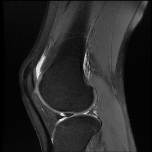 File:Bucket-handle meniscus tear (Radiopaedia 65700-74809 Sagittal PD fat sat 16).jpg